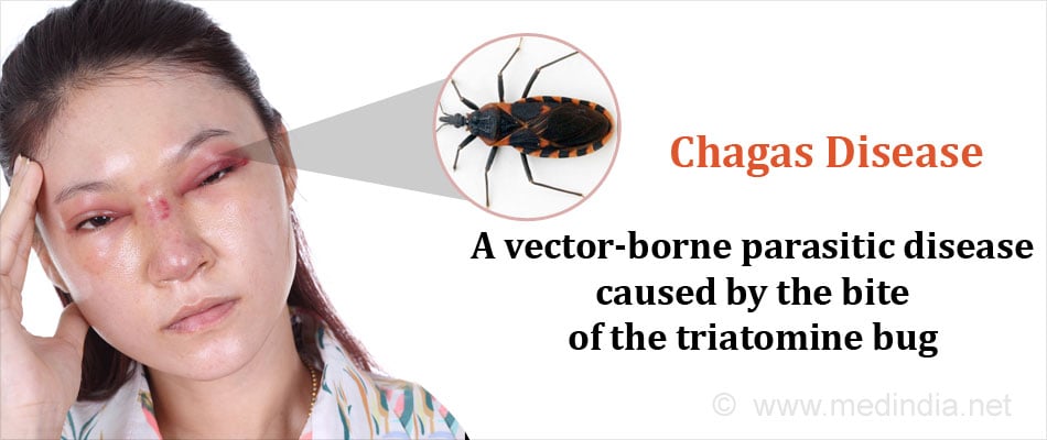 Chagas Disease - Causes, Symptoms, Diagnosis, Treatment & Prevention