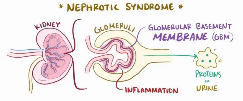 Unveiling the Link between Fairness Creams and Nephrotic Syndrome -  Civilsdaily